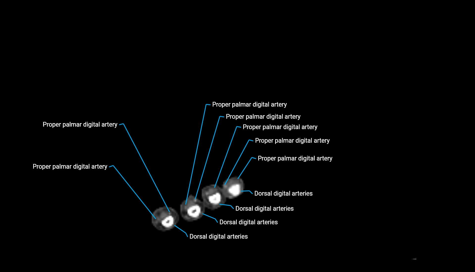 CTA upper limb axial cross sectional anatomy labelled image 34 (2).webp